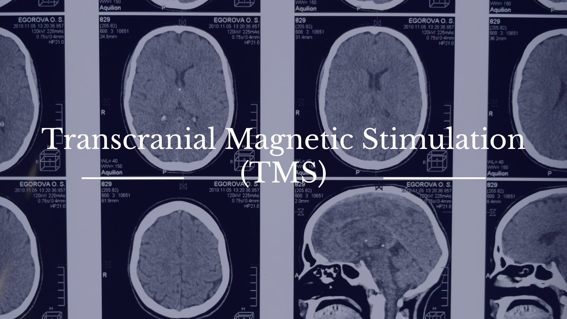 Renewed Light Mental Health Introduces Addition of TMS Therapy